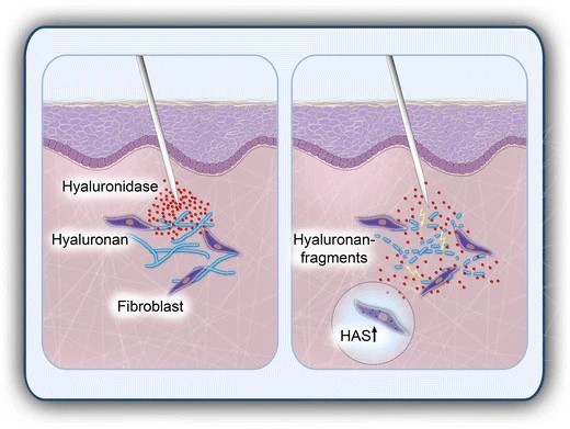 Hyaluronidase baut dermale Hyaluronan ab, um die ECM-Permeabilität und die Arzneimitteldiffusion zu verbessern.