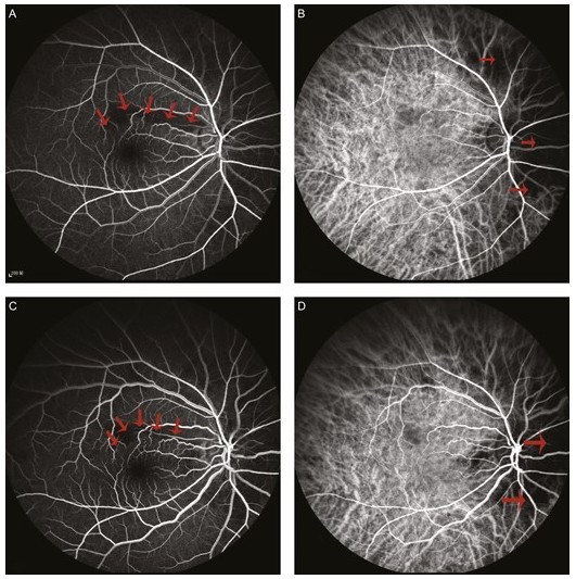 Endovaskuläre Hyaluronidase-Anwendung durch superselektive Angiographie zur Rettung von Blindheit, die durch Hyaluronsäureinjektion verursacht wurde.