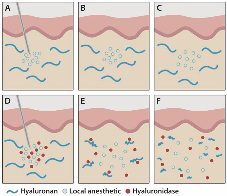 Wirkungsmechanismus der Hyaluronidase zur Erhöhung der Bioverfügbarkeit injizierter Medikamente.