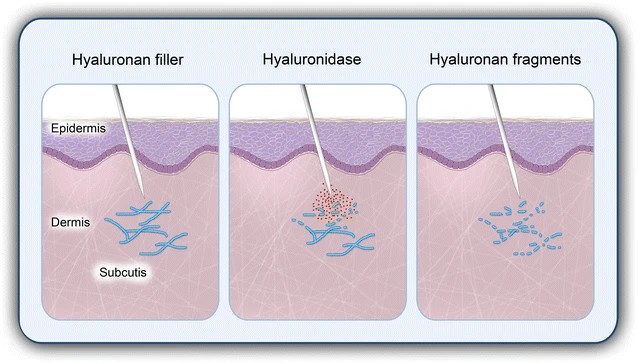 Hyaluronidase wirkt als reversibler Hyaluronsäure-Filler.