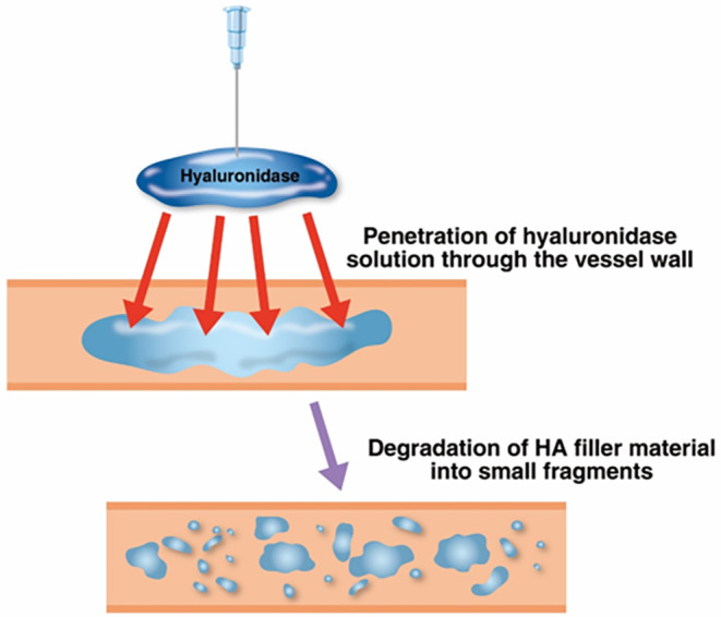 Hyaluronidase dringt in die Gefäßwand ein und baut das Hyaluronsäure-Filler in kleine Fragmente ab.