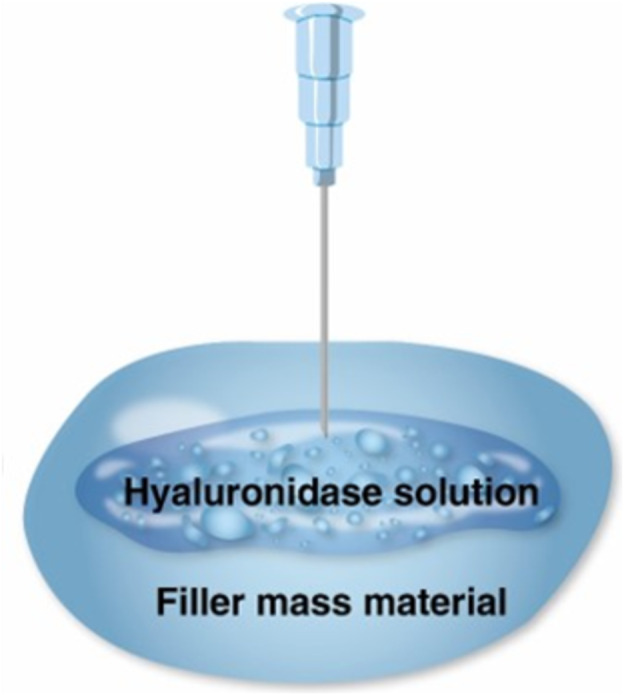 Hyaluronidase-Lösung baut das Füllmaterial ab.