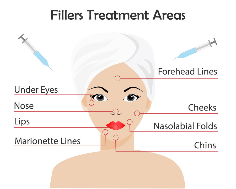 Die Lage des Fillers beeinflusst die Hyaluronidase-Dosierung zur Auflösung.