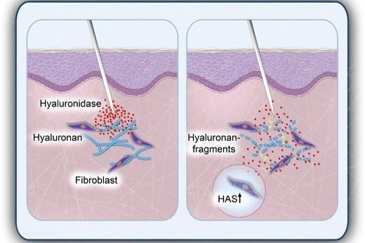 Hyaluronidase: Über Filler hinaus – Weitere Anwendungen und Einsatzmöglichkeiten