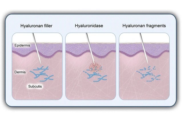 Hyaluronidase wirkt als Filler-Löser.