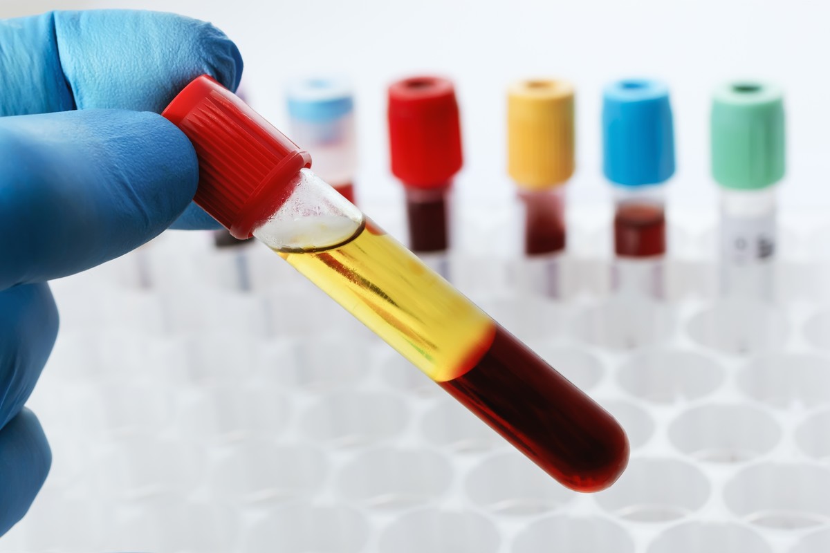 Testen der Diaminoxidase-Spiegel im Serum.