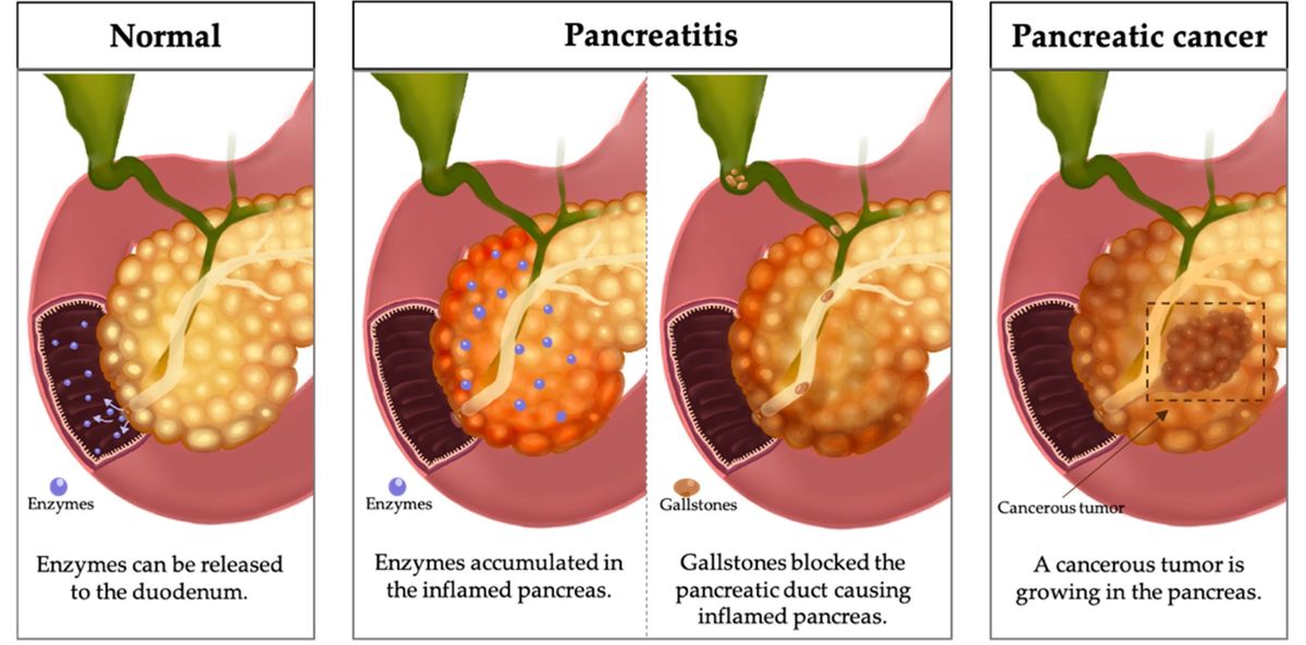 Die Supplementierung mit Pancreatin ist in klinischen Bedingungen wie Pankreatitis und Pankreaskrebs erforderlich.